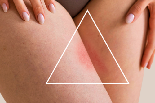 CUISSES QUI FROTTENT : COMMENT LES ÉVITER EN ÉTÉ ?